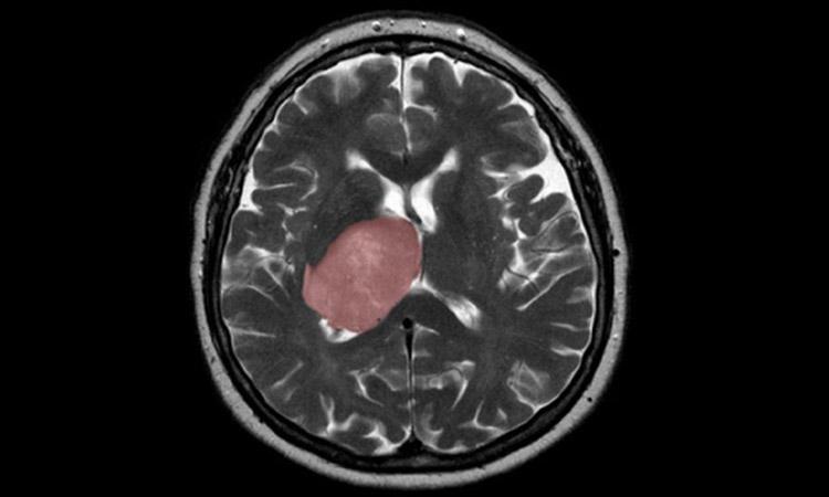 Science-Brain cancer-parasite