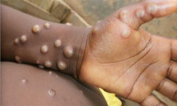 Global-cases-of-monkeypox-surpass-1,000