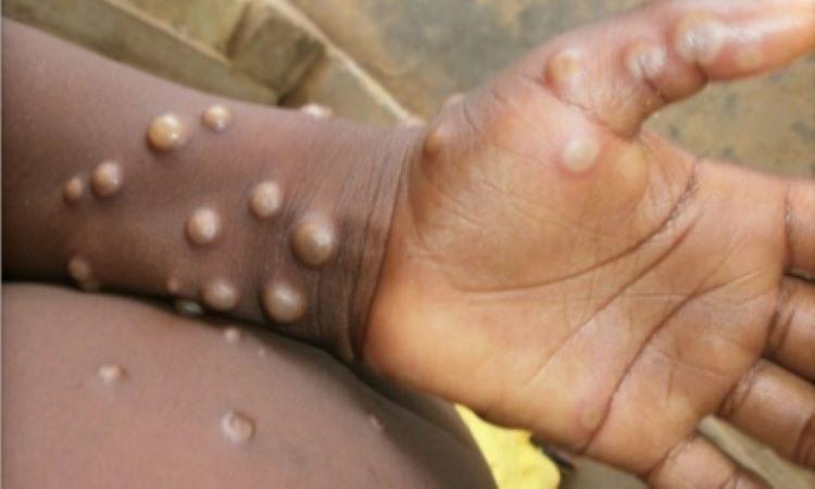 monkeypox-vaccines