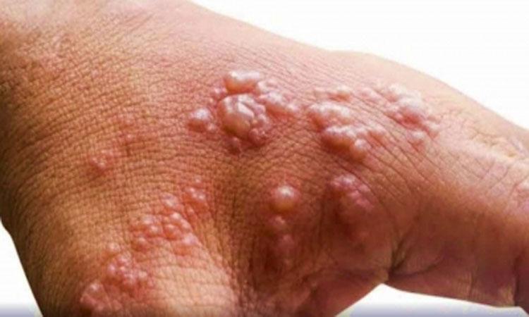 monkeypox-pandemic
