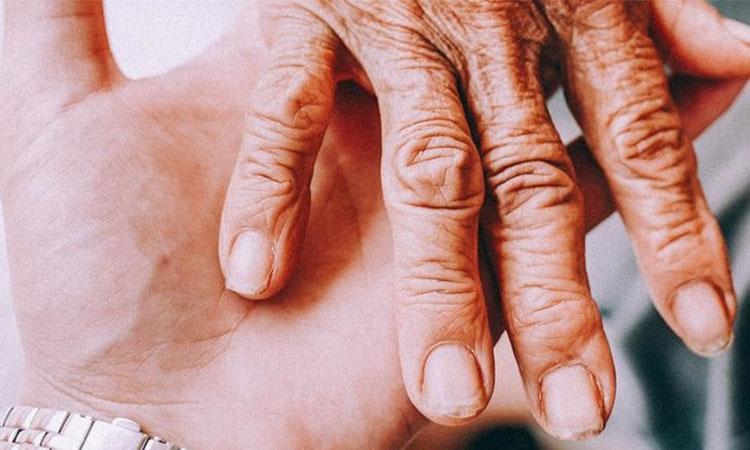  Rheumatoid-Arthritis