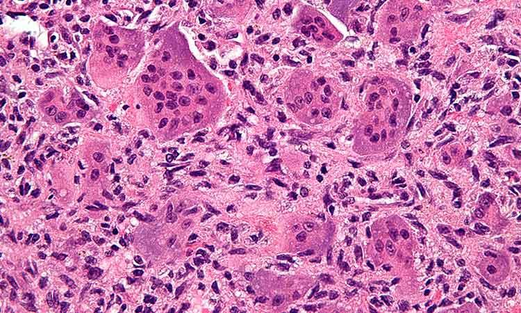 Tumour-cells-bone