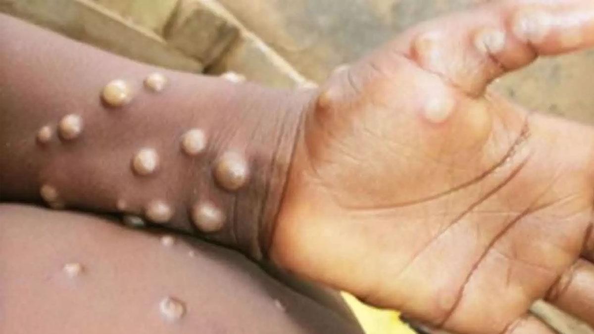 Mpox